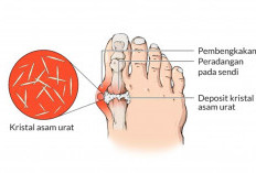 Beberapa Cara Alami Atasi Asam Urat, Ampuh Hilangkan Bengkak Hingga Rasa Nyeri