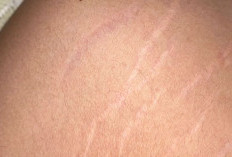 Penyebab Munculnya Stretch Mark di Paha