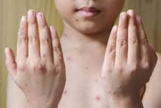 Waspada! Penyakit Mpox Sasar Anak-anak