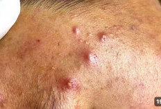 Obat Alami Untuk Menyembuhkan Jerawat Pada Wajah, Simak Baik-Baik!