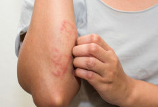 Bukan Sekadar Pantang Makanan ! Inilah Rahasia Mengatasi Dermatitis Atopik pada Anak