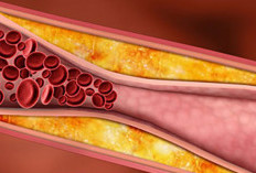 Kenali Kolesterol LDL dan HDL, Apa Itu?
