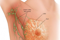 Deteksi Dini Kanker Payudara dengan Mamografi atau Sadari