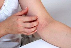 Kulit Bisa Jadi Cermin Kesehatan Ginjal, Ini Gejala yang Harus Dikenali !