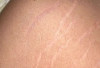 Penyebab Munculnya Stretch Mark di Paha